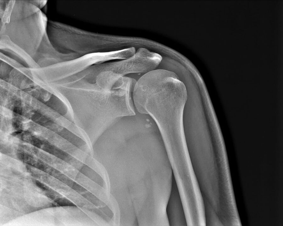 Radiographie de l'arthrose de l'articulation de l'épaule du 2e degré de gravité