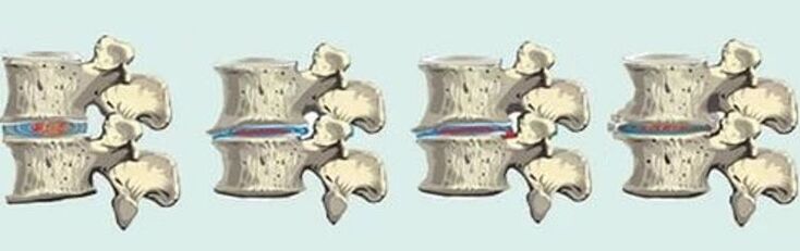 lésion de la colonne vertébrale en cas d'ostéochondrose thoracique