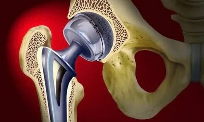 arthroplastie de la hanche pour l'arthrose