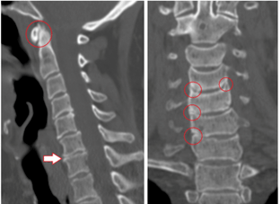 La TDM montre des vertèbres et des disques endommagés de hauteur hétérogène en raison d'une ostéochondrose thoracique