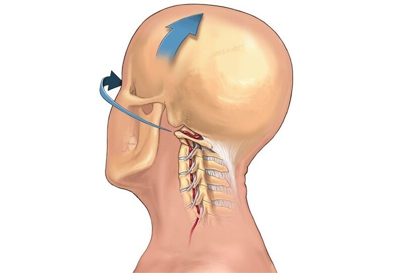 craquement du cou en tournant la tête comme symptôme d'ostéochondrose cervicale