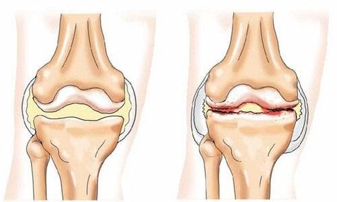 articulation du genou saine affectée par l'arthrose