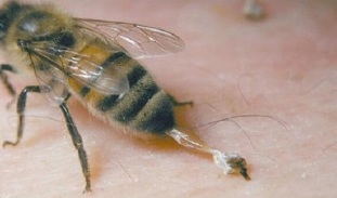 traitement de l'arthrose de la hanche par les abeilles