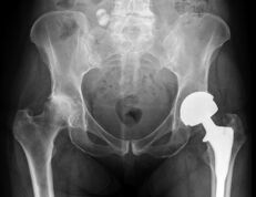 diagnostic d'arthrose de l'articulation de la hanche