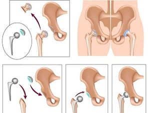 endoprothèse pour l'arthrose de l'articulation de la hanche