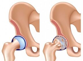 symptômes de l'arthrite de la hanche